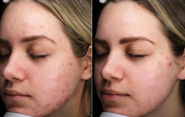 Before and after comparison of a woman's face with acne on a plain background