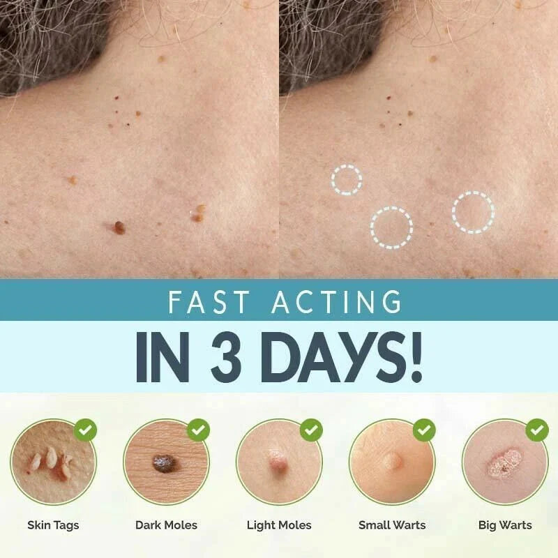 SKIN TAG REMOVER LIQUID MOLE WART ACNE PIMPLE PATCH REMOVAL SPOT SAFE & FAST Ausie Sales