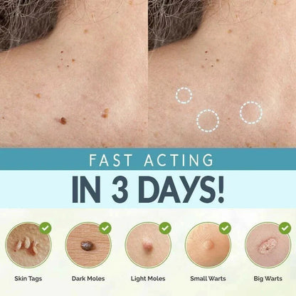 SKIN TAG REMOVER LIQUID MOLE WART ACNE PIMPLE PATCH REMOVAL SPOT SAFE & FAST Ausie Sales