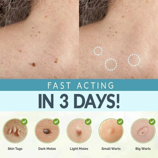 SKIN TAG REMOVER LIQUID MOLE WART ACNE PIMPLE PATCH REMOVAL SPOT SAFE & FAST Ausie Sales