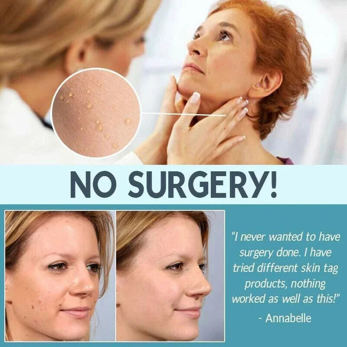 SKIN TAG REMOVER LIQUID MOLE WART ACNE PIMPLE PATCH REMOVAL SPOT SAFE & FAST My Store