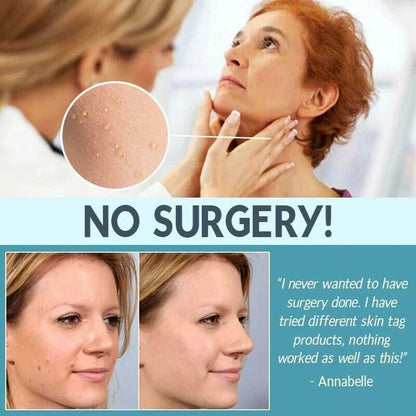 SKIN TAG REMOVER LIQUID MOLE WART ACNE PIMPLE PATCH REMOVAL SPOT SAFE & FAST My Store