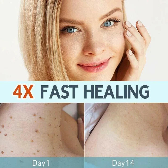 SKIN TAG REMOVER LIQUID MOLE WART ACNE PIMPLE PATCH REMOVAL SPOT SAFE & FAST My Store