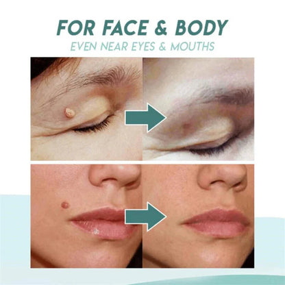 Skin Tag Remover Acne Pimple Patch Removal Facial Care Spot Plaster My Store