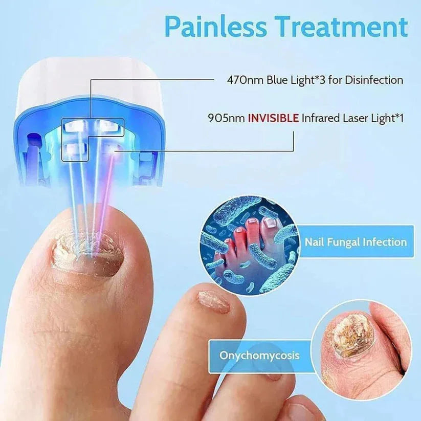 Nail treatment device with blue light and infrared laser on a finger, showing nail fungal infection and onychomycosis.

