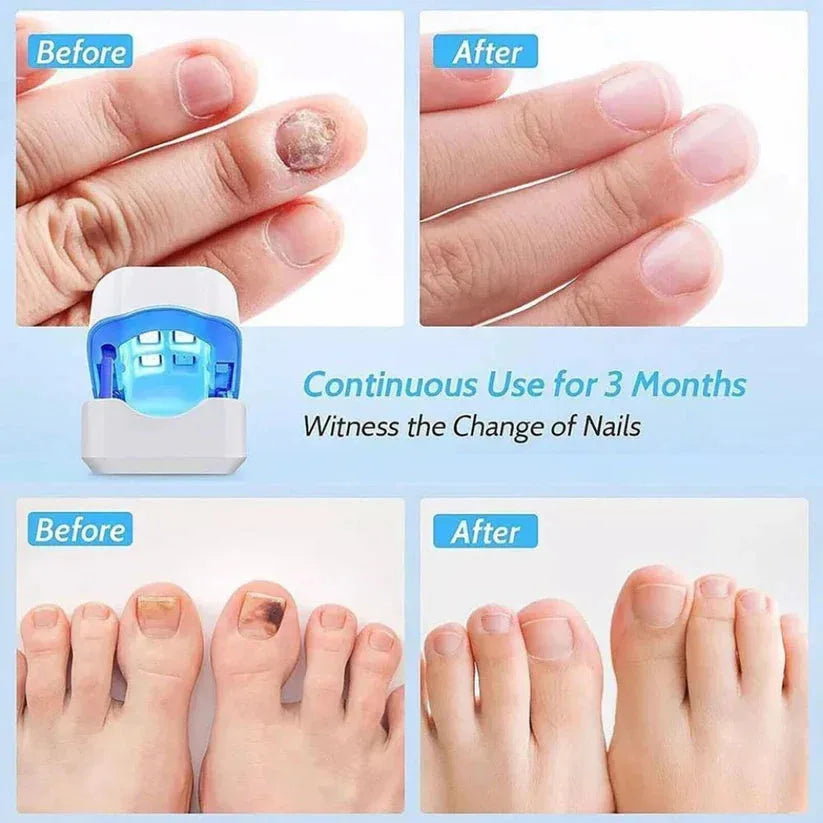 Before and after comparison of nail treatment using a device, with text indicating continuous use for 3 months.

